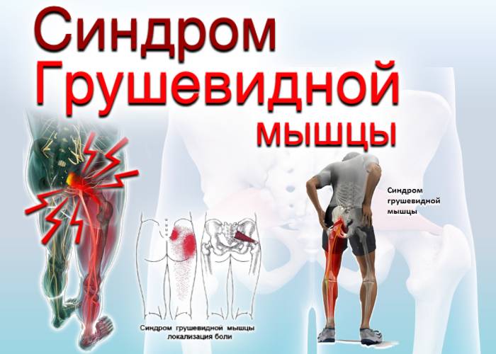 Причины, симптомы и лечение синдрома грушевидной мышцы