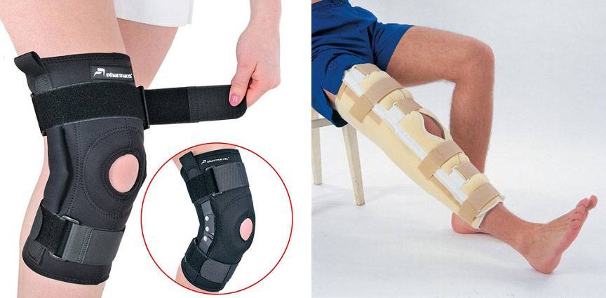 Надрыв связок колена – частичный разрыв связок коленного сустава: лечение обязательно?