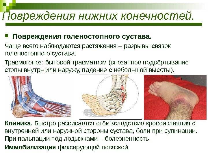 Лечение вывихов, растяжений, разрывов связок