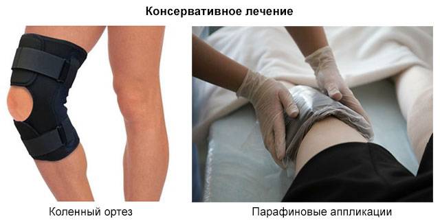 Травмы связок колена