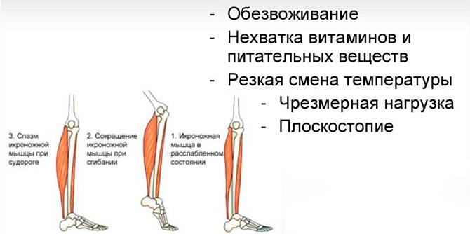 Судороги в ногах: причины, профилактика, что делать, как лечить