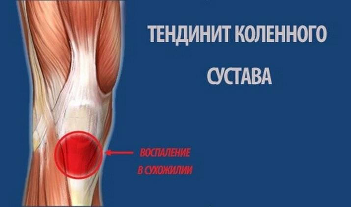 Боли в колене во время ходьбы | что делать, если болит колено при ходьбе? | лечение боли и симптомы болезни на eurolab