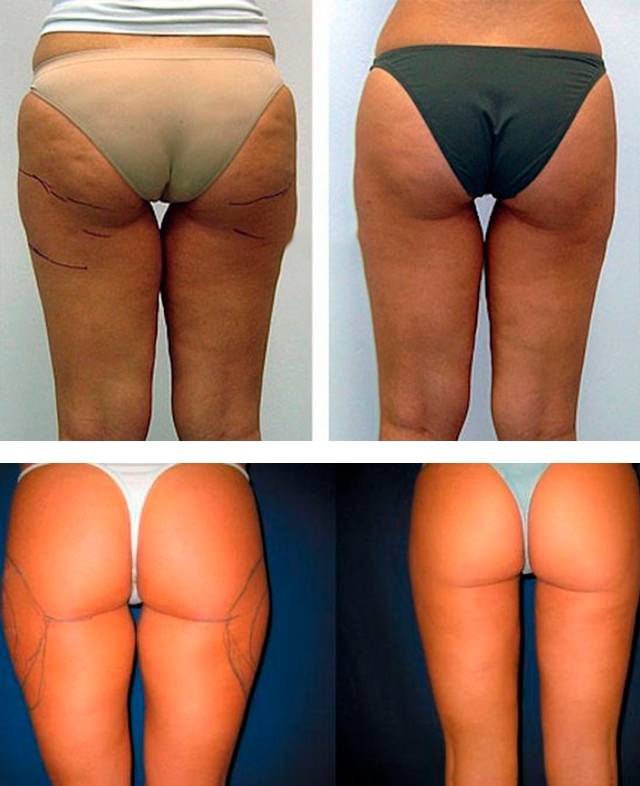 Thigh Lift Gallery - Before and After