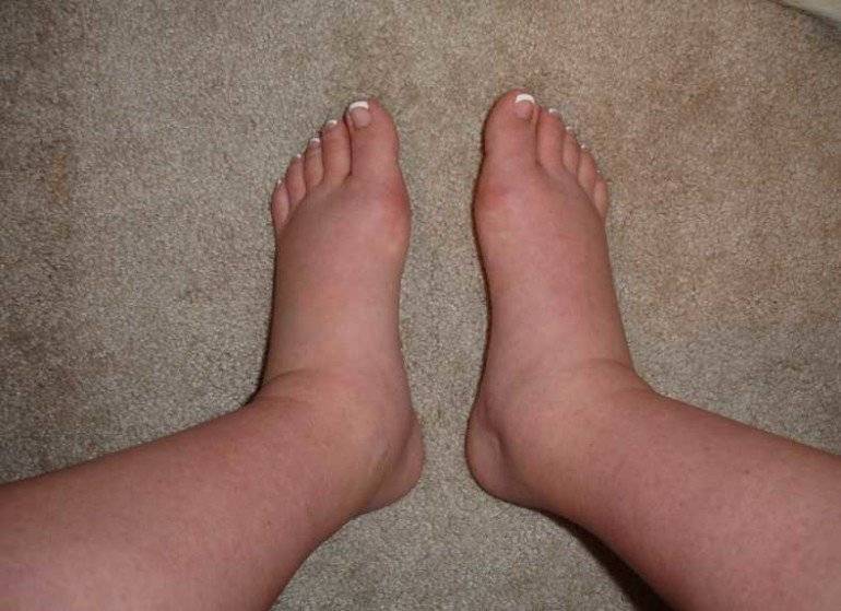 Отеки ног. причины отека ног. лечение отека ног.