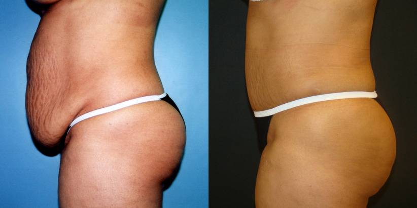 10 способов подтянуть кожу тела после похудения или родов