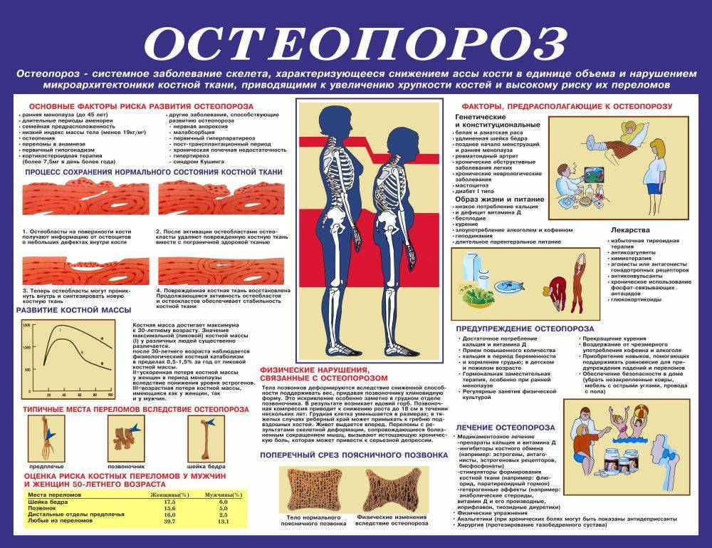 Остеопороз: лечение профилактика остеопороза, диагностика.