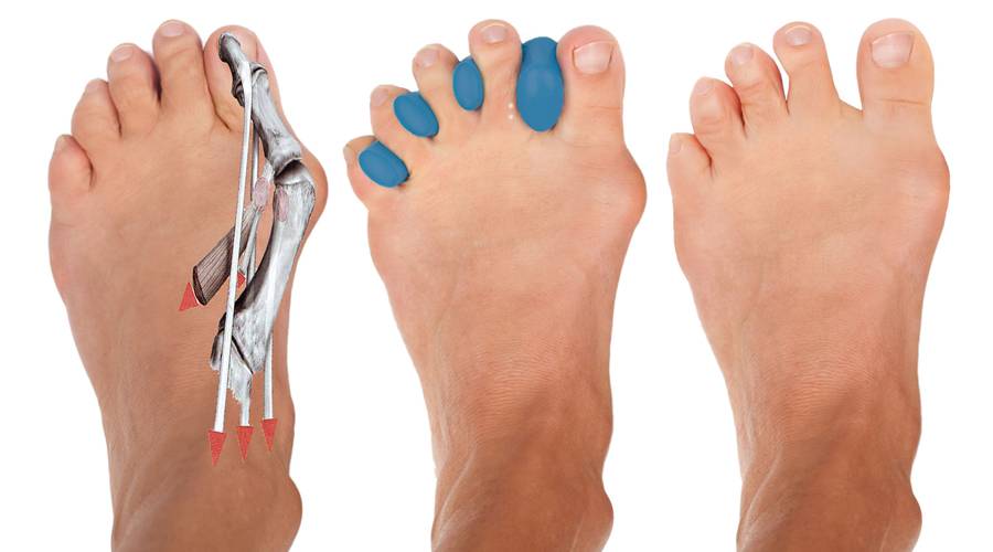 Косточка на большом пальце ноги: причины возникновения и способы лечения