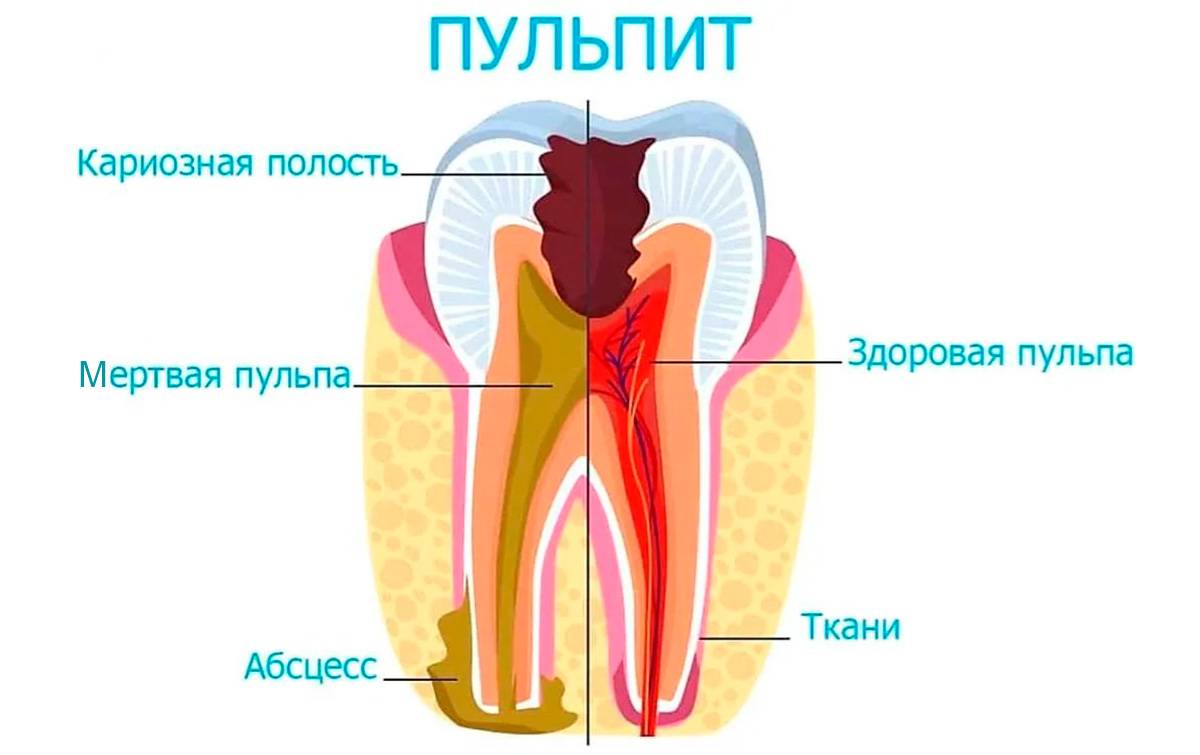 Пульпит Зуба Лечение Цена