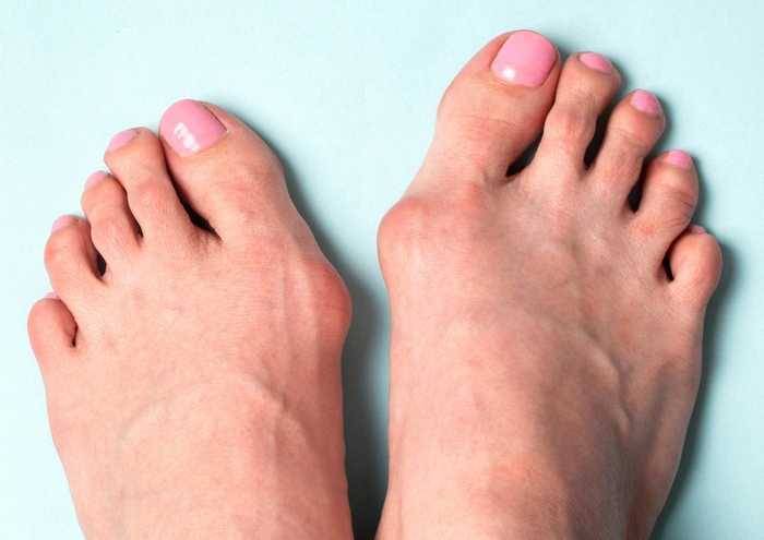 Косточка на ноге: 7 не эффективных народных методов для лечения дома — ladisten