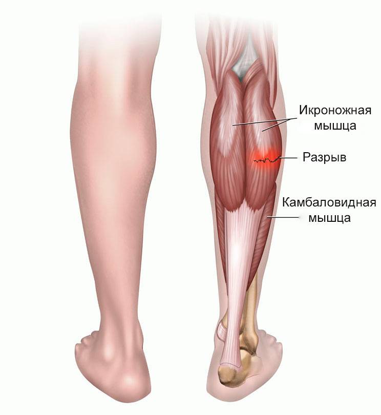 Лечение при растяжениях и разрывах связок колена - диагностика, первая помощь, восстановление связок