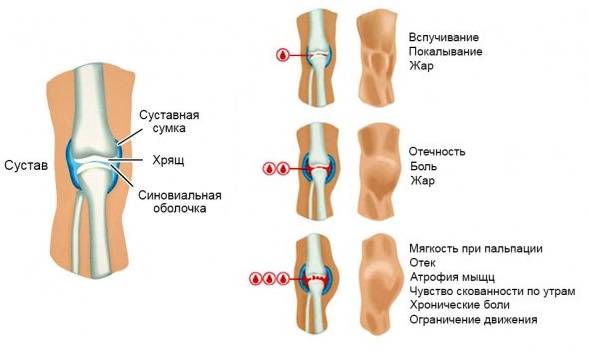 Повреждение связок коленного сустава — симптомы и лечение в домашних условиях, как долго заживает травма колена и мазь для связок