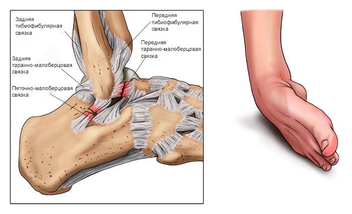 Лечение при растяжениях и разрывах связок колена: первая помощь, восстановление