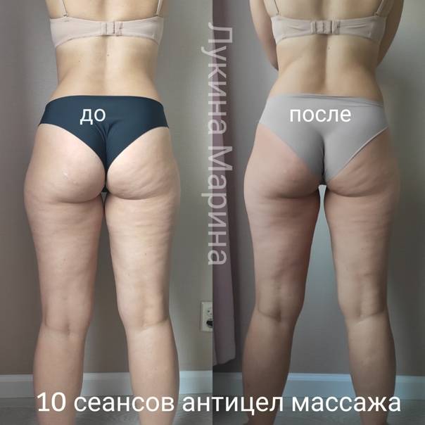 Целлюлит не уходит при занятиях спортом и похудении: что делать?