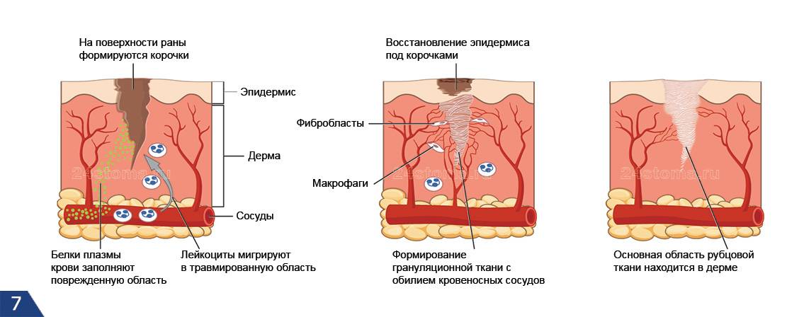 Фото Рубцов На Коже