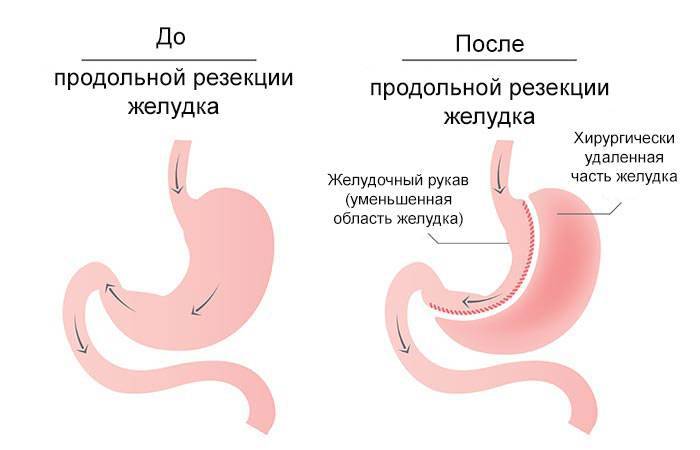 Продольная резекция желудка фото