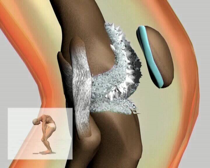 Отложение солей. Отложение солей в колене. Отложение солей в суставах. Отложение солей в суставах колена.