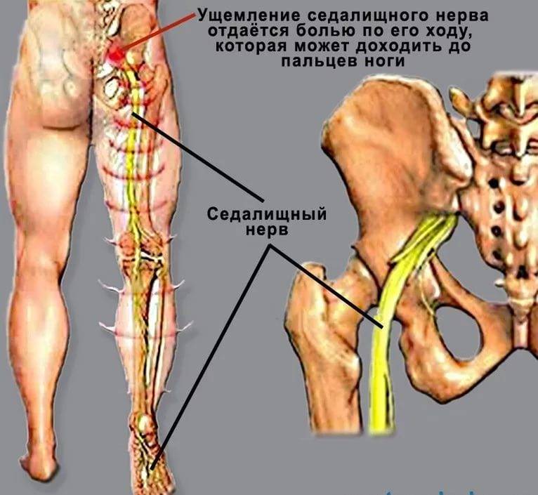 Где находится у человека седалищный нерв фото и как болит лечение симптомы