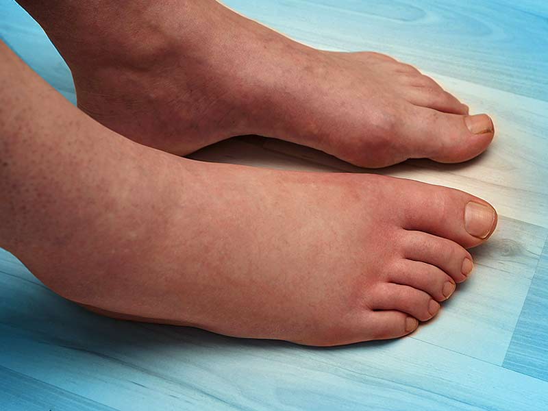 Лимфостаз нижних конечностей: чем грозят отеки ног? | компетентно о здоровье на ilive
