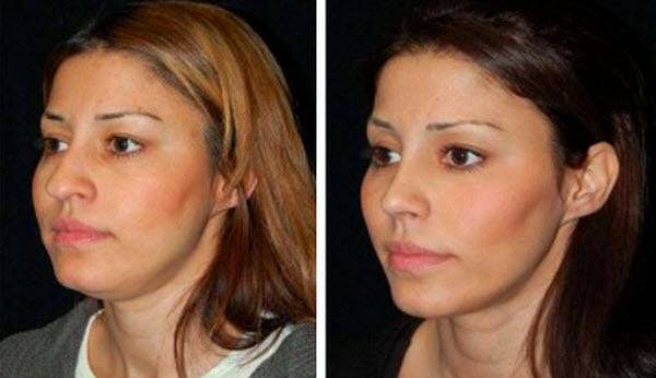 Как уменьшить объем щек и сделать лицо худее без операций
