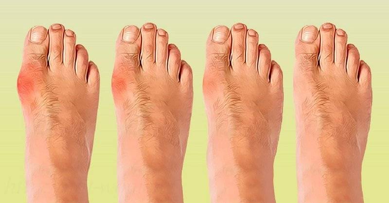 Косточки на большом пальце ноги: от чего растут шишки на ногах?