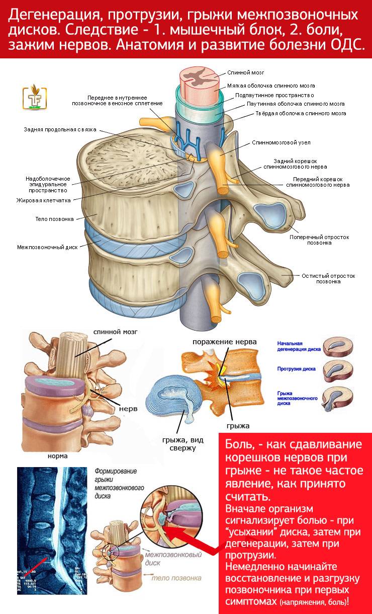 Грыжа позвоночника как лечить. Что такое протрузия дисков позвоночника поясничного отдела. Грыжа и протрузия поясничного отдела позвоночника. Грыжи дисков позвоночника и протрузии. Дорсальные протрузии дисков.