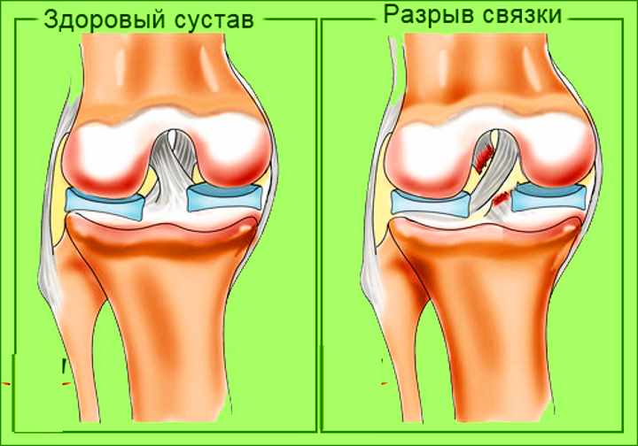 Разрыв сочленений