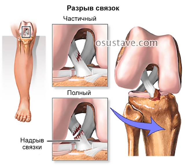 Травмы связок колена: виды повреждений и способы реабилитации