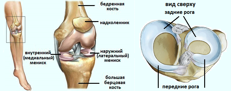 Разрыв мениска коленного сустава. менискэктомия – хирургическое лечение разрыва мениска.