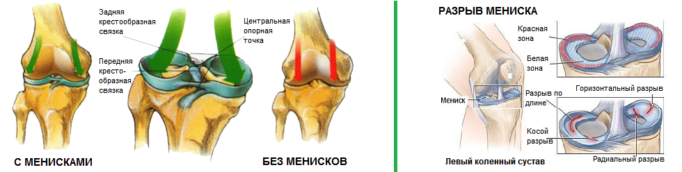 Мениск. разрыв мениска колена