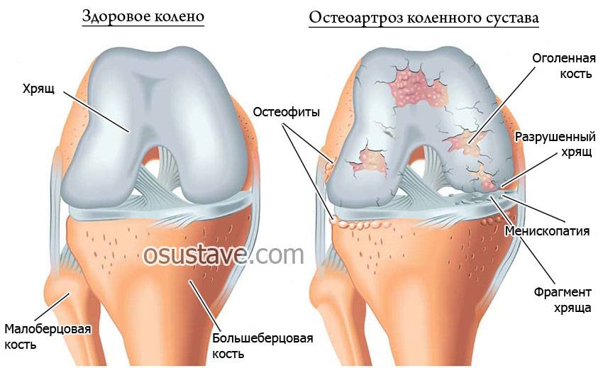 Хрустят колени при сгибании. Пателлофеморальный болевой синдром.