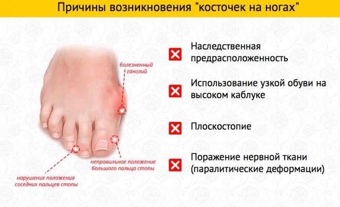 Косточка на ноге — что делать, если болит и растет. лечение в домашних условиях - полонсил.ру - социальная сеть здоровья - медиаплатформа миртесен