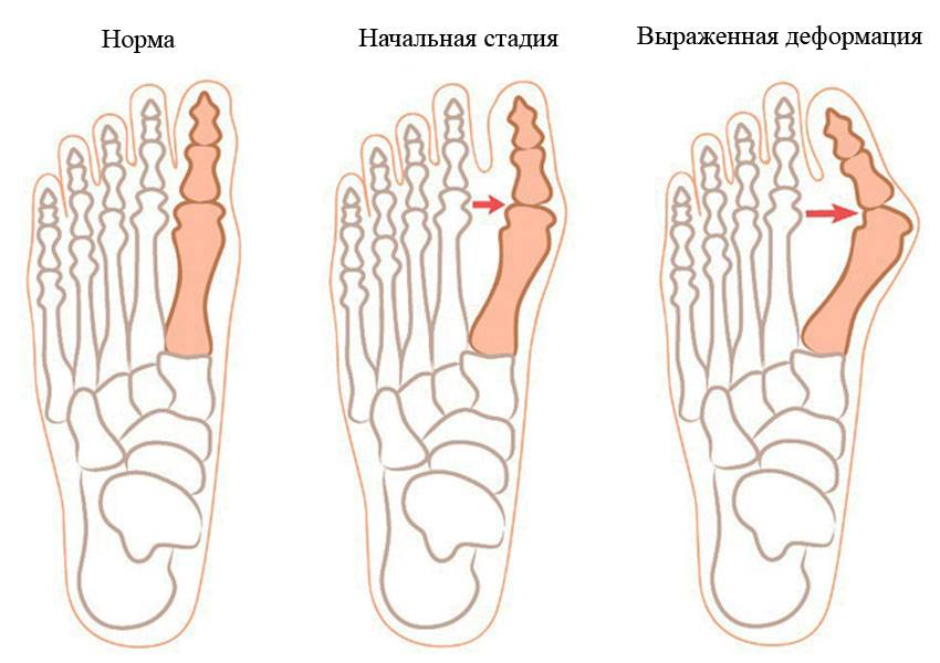 Артроз пальцев ног