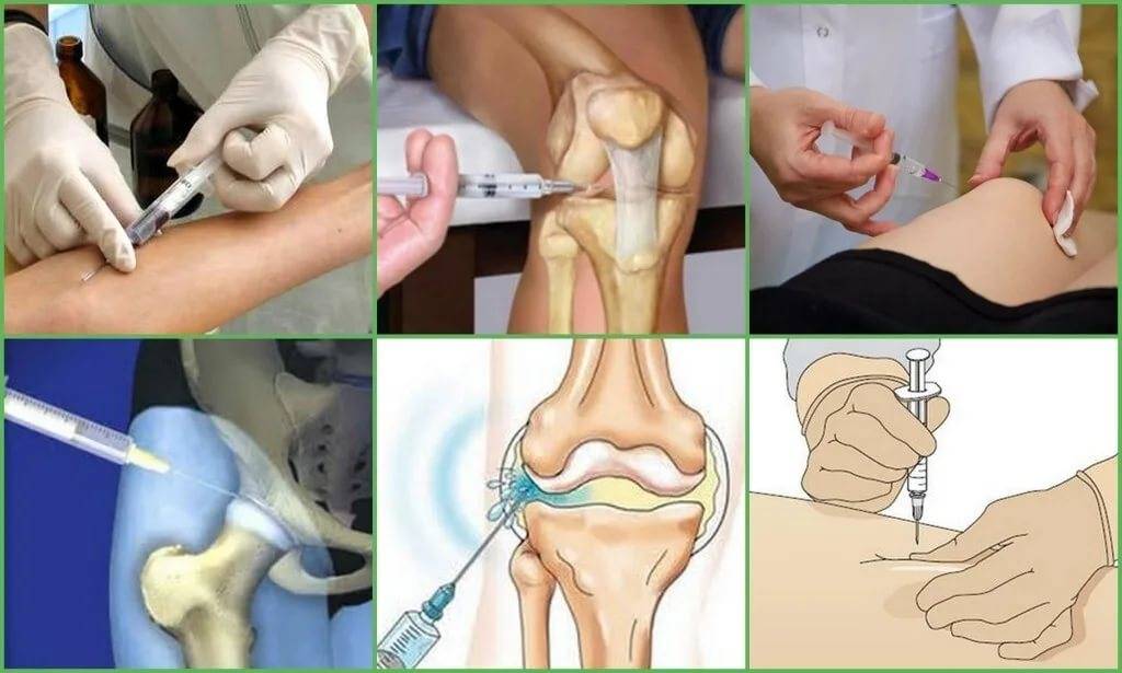 Эффективные уколы в коленный сустав при артрозе: препараты и их применение