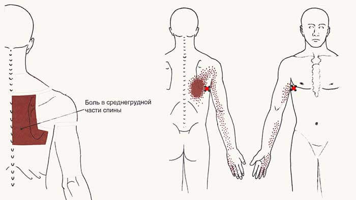 Боль под правой лопаткой сзади со спины: причины, лечение