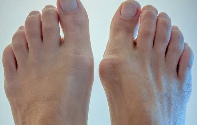 Косточка на большом пальце ноги. причины и 5 способов лечения в домашних условиях