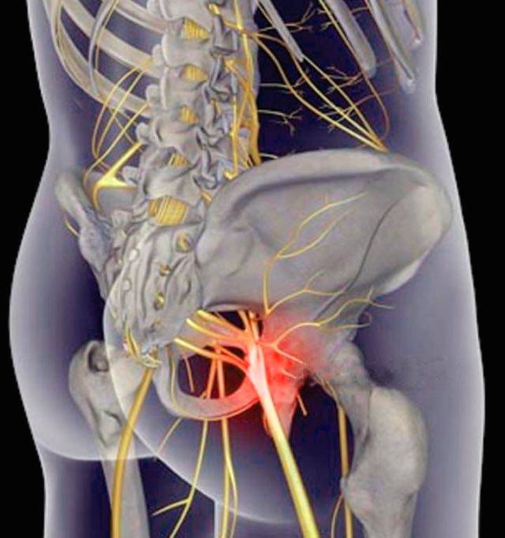 Что такое защемление нерва. Люмбоишиалгия седалищного нерва. Остеохондроз люмбоишиалгия. Вертеброгенная люмбоишиалгия позвоночника.
