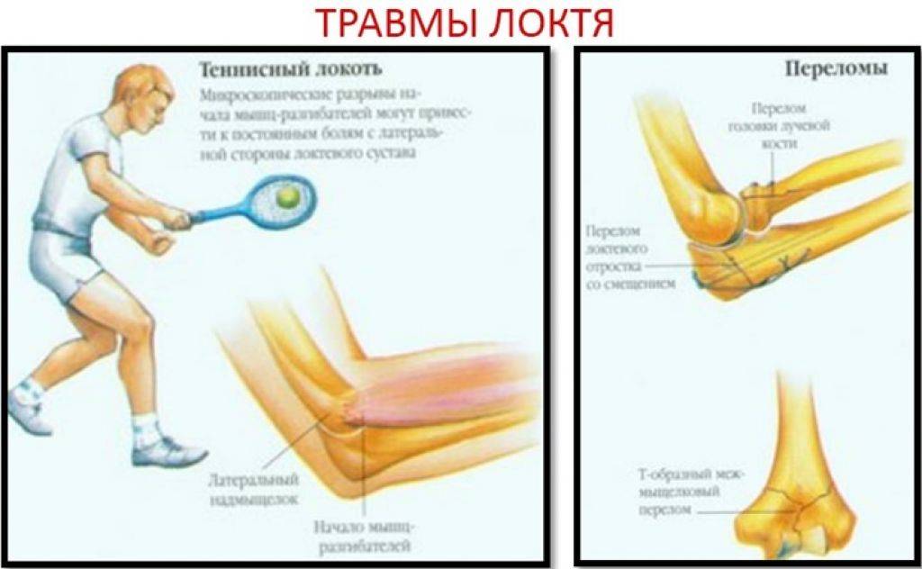 Лечение артроза локтевого сустава - нолтрекс.