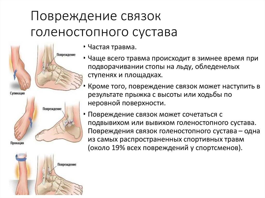 Лечение растяжения связок голеностопа, повреждение или разрыв связок голеностопного сустава.