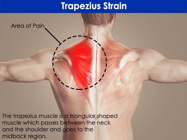 Растяжение трапециевидных мыщц при боли в верхней части спины