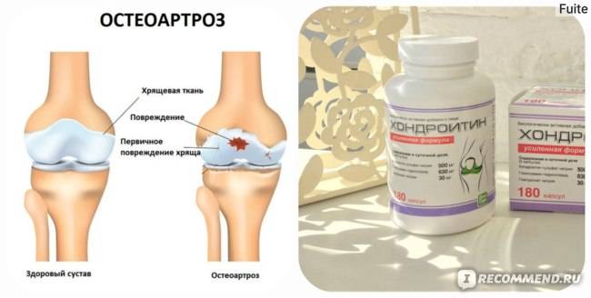 5 наиболее популярных хондропротекторов при артрозе