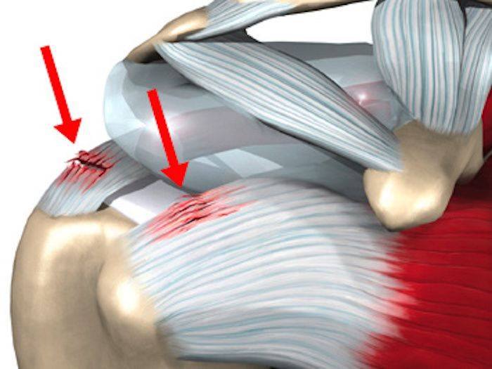 Rotator Cuff мышца