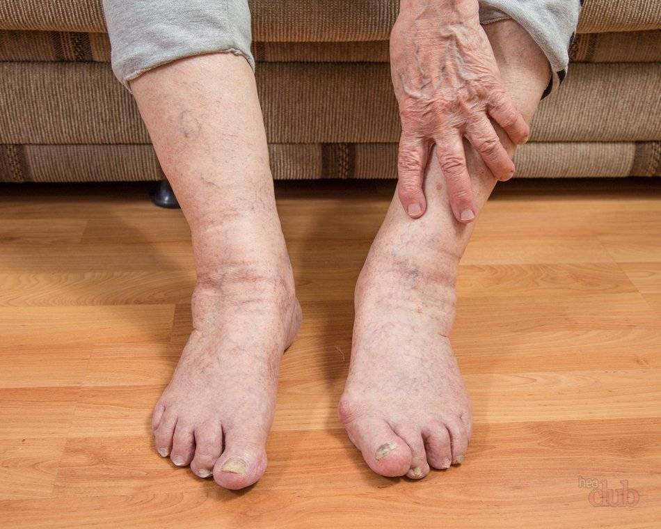 Отек ног у пожилых людей: причины и лечение