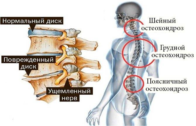 Острая боль в спине - что делать, как снять болевой синдром, куда обращаться