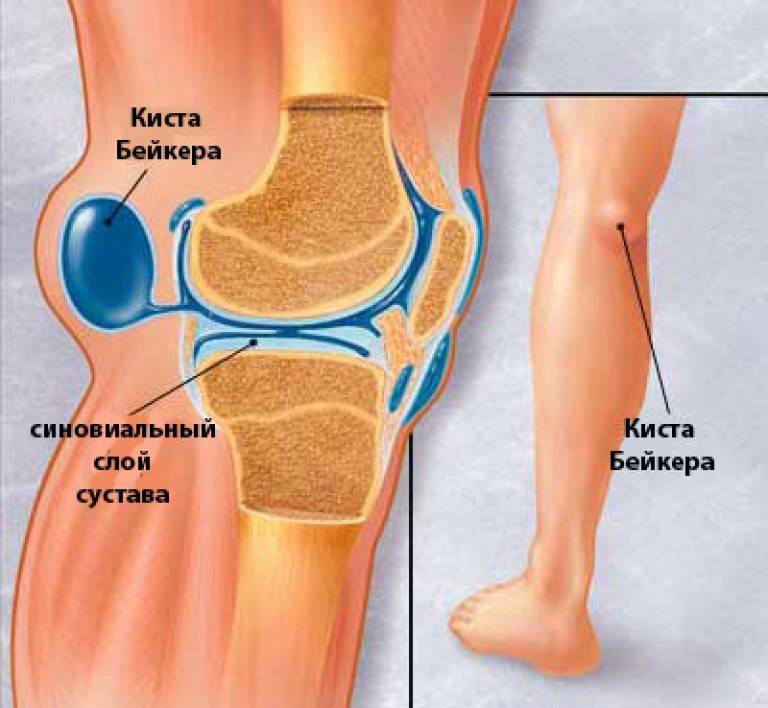 Болит колено, боль в колене правой или левой ноги