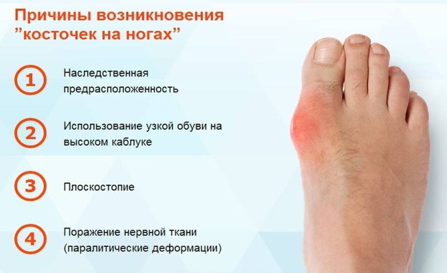 Косточка на большом пальце ноги: причины возникновения и способы лечения