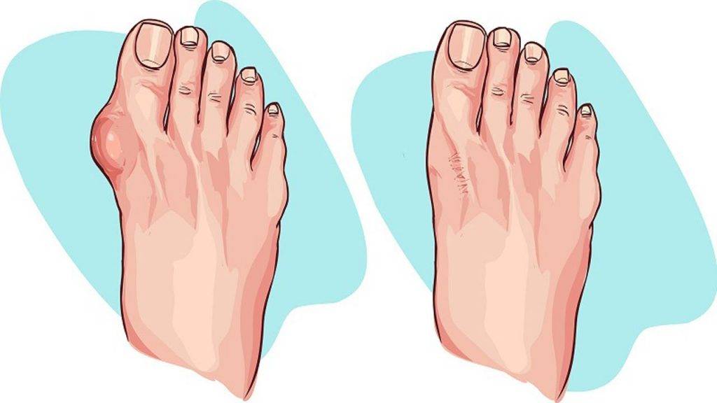 Артроз пальцев ног: симптомы и лечение
