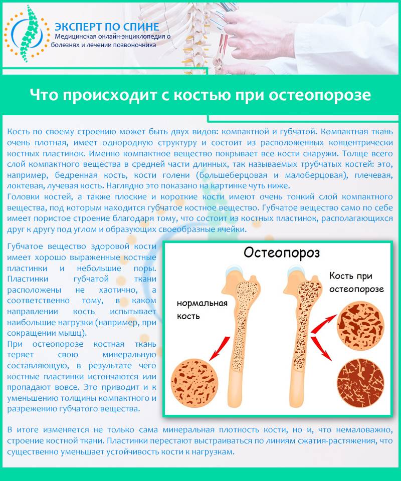 Остеопороз: симптомы, диагностика и лечение остеопороза. как снизить риск переломов: профилактика остеопороза