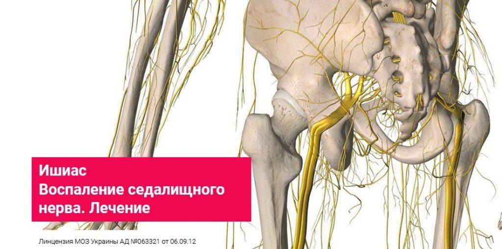 Защемление седалищного нерва: подробно о симптомах и лечении